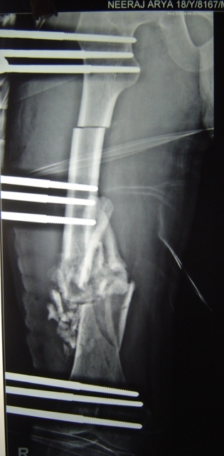 X-Ray Immediately After Surgery